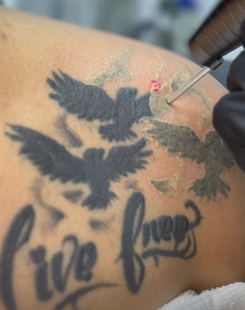 icon tattoo removal 2